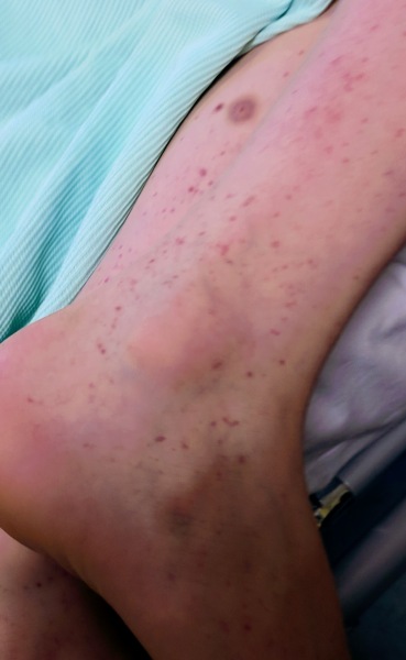 Small patch of what I think is petechiae on DD back. I am spiralling with healt anxiety