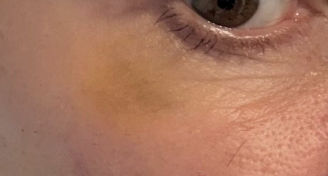 (Pic) Bruising from Botox