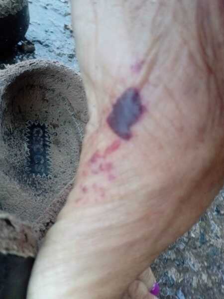 Blood blister (WARNING: PHOTO ATTACHED)