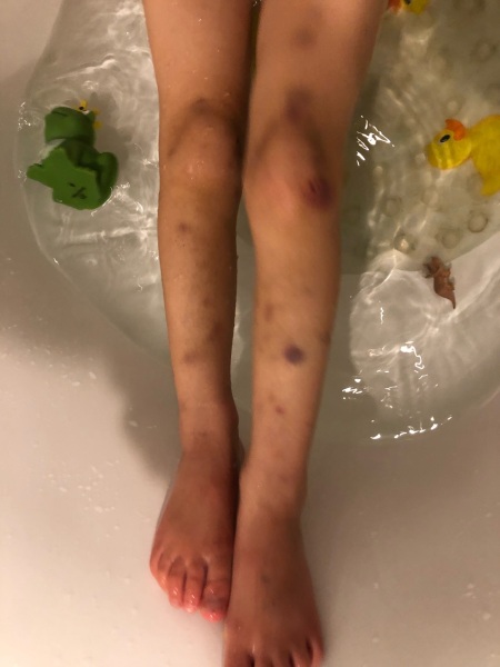 Is this a concerning amount of bruises?