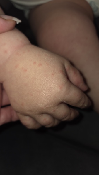 Does this look like the start of chickenpox?