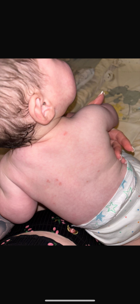 Red marks under baby skin