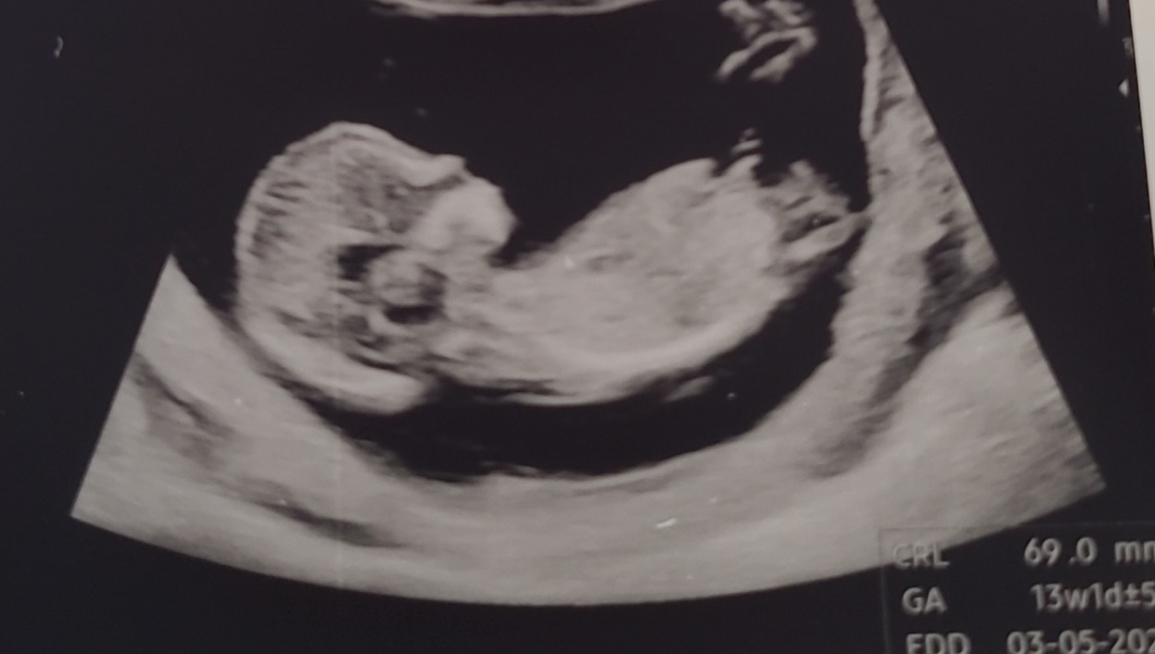 Boy or girl? Annoying guesses?