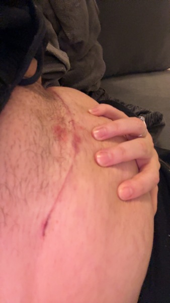 Painful c section scar