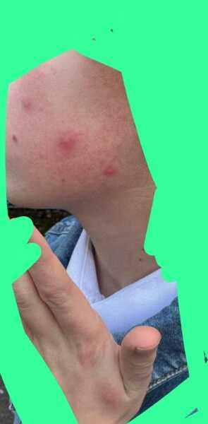 Chicken pox or bites?