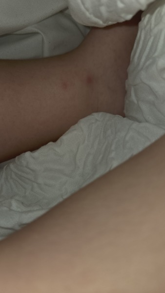 Does this look like the start of chickenpox?