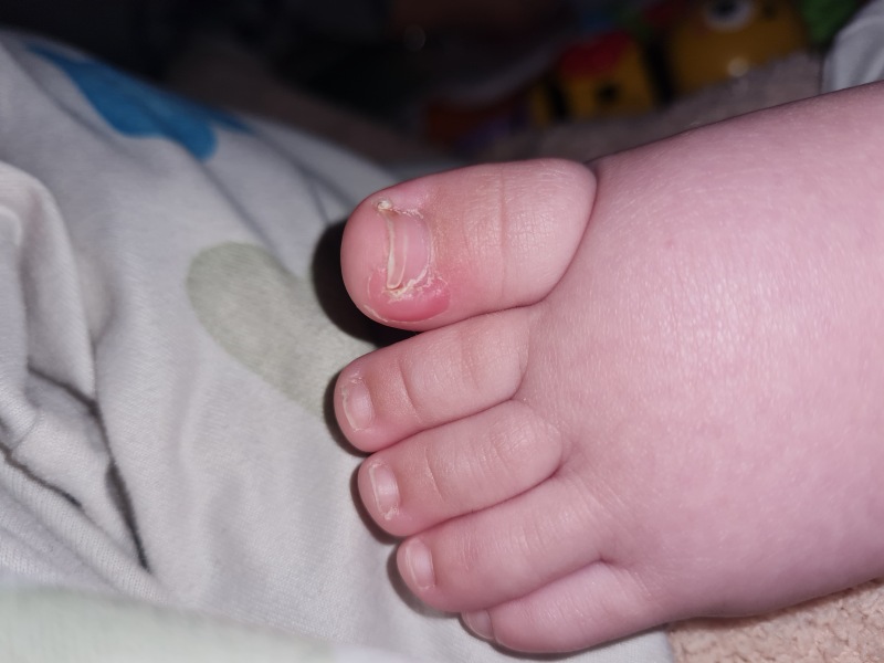 Baby with ingrown toenails? Anyone else?