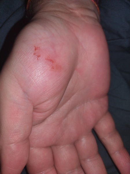 To call NHS 24 over a minor cat bite?