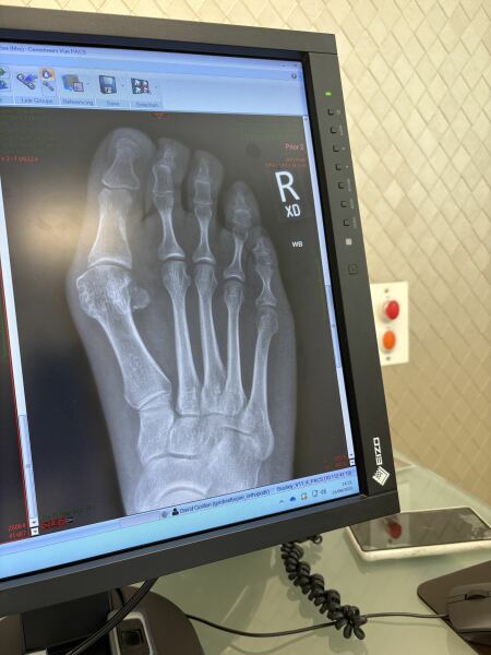 How the hell to cope with bunions?!