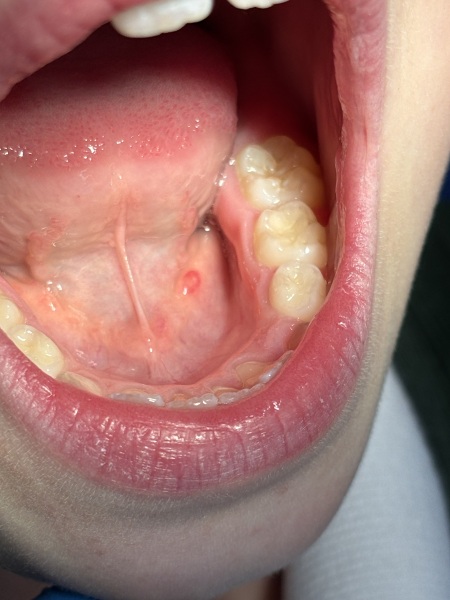 What is this in child’s mouth?