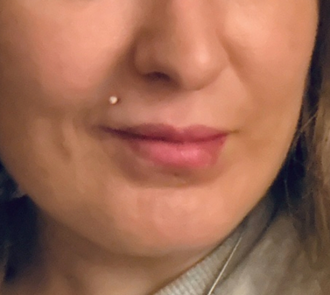 If you've had your lips plumped ...