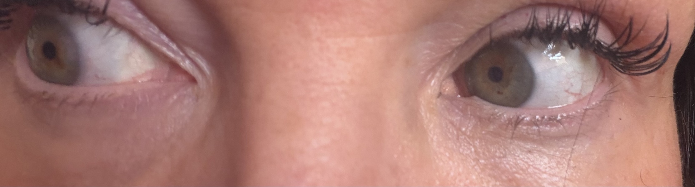 Tear trough filler, whats your experience?