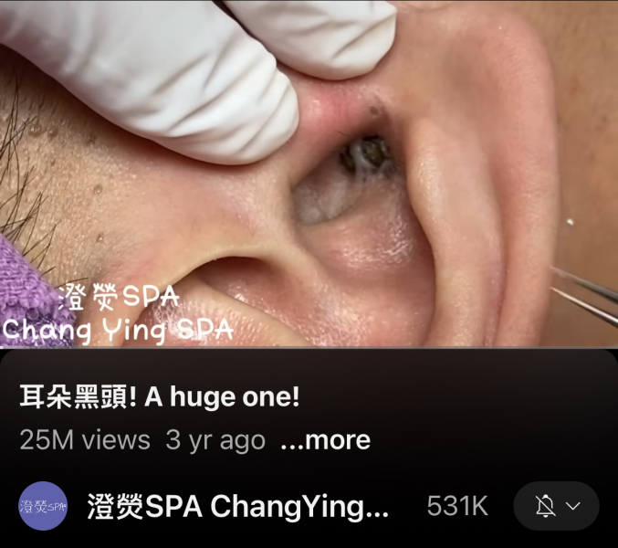 Burst abscess type paranoia