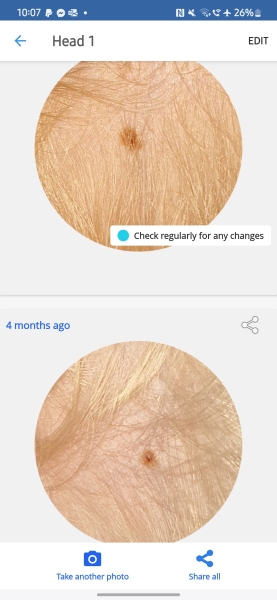 Would this growing mole worry you?