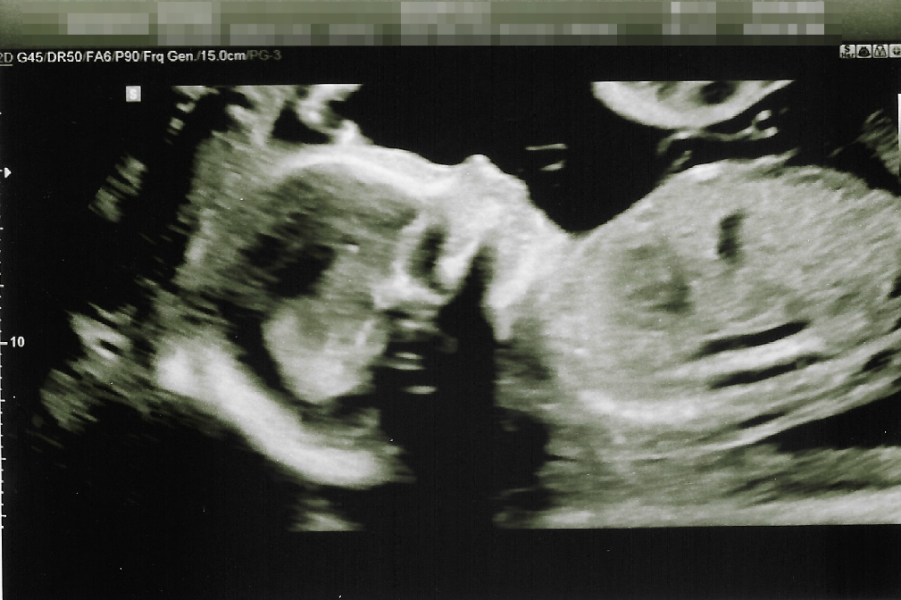 Pregnant with first baby