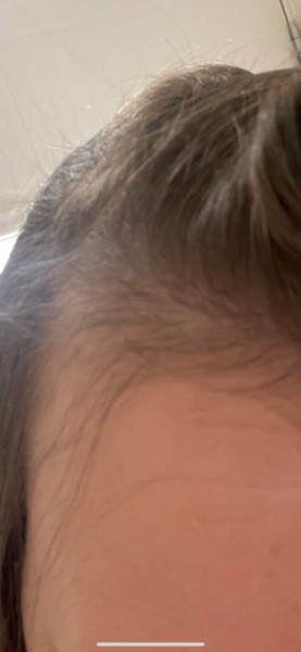 Hair loss prevention