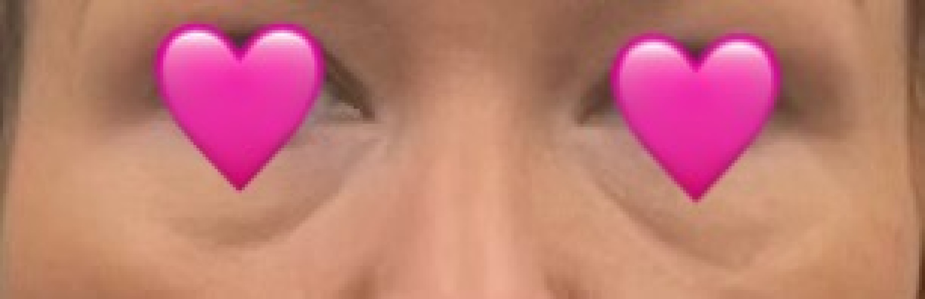 Under eye hollows- help!