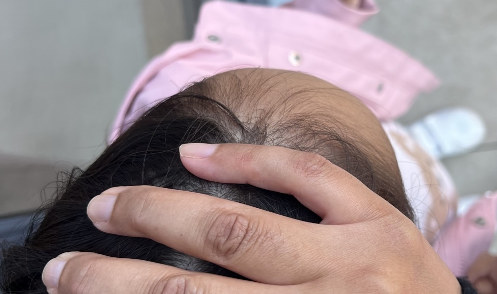 One side prominent forehead in 3 year old