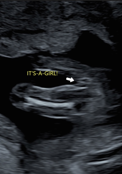 Had a scan today… is this definitely a girl?