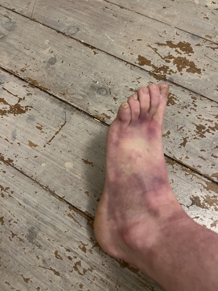 Have I hurt my foot?