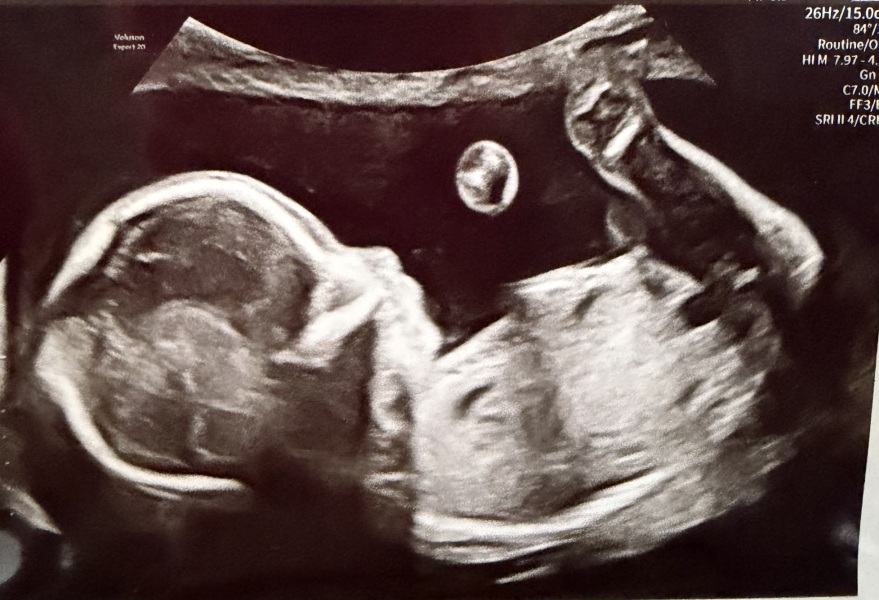Would you guess the gender from this 20 weeks scan?