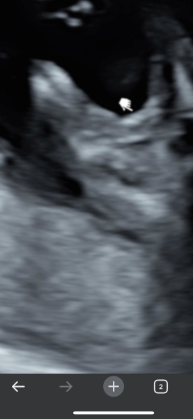 Told boy at 15 weeks and girl at 20 week scan