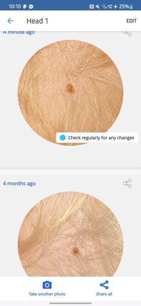 Would this growing mole worry you?