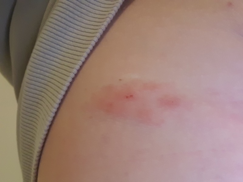 Shingles at 26 weeks pregnant