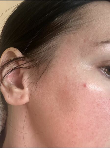 Are there any dermatologists here that can help please?