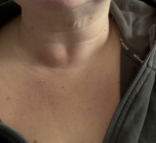 Mounjaro 10st (or more) to lose Thread 9