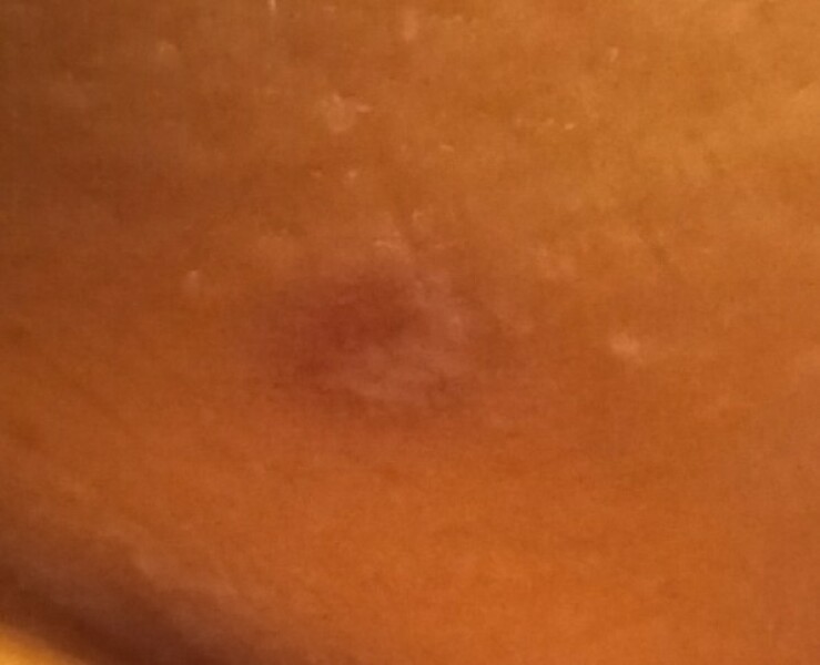 Any dermatologists here? Df thinks I may have skin cancer?