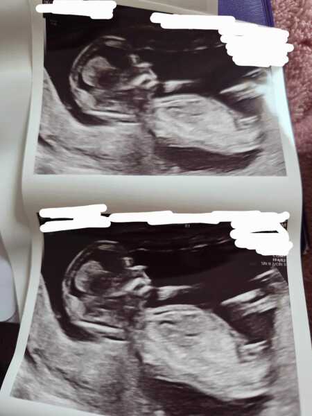 12 week scan