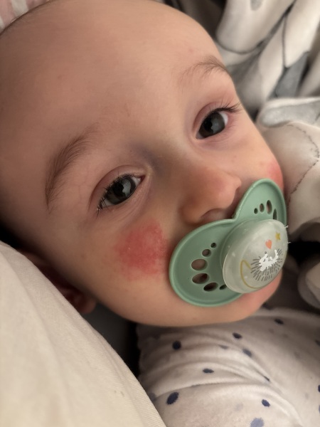 Baby eczema 😢