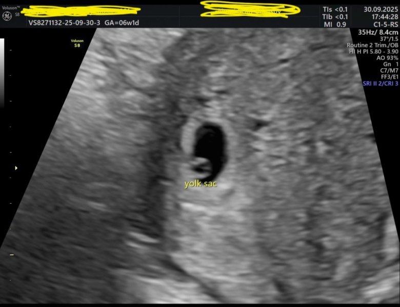 6 week scan but measuring less should I be worried?