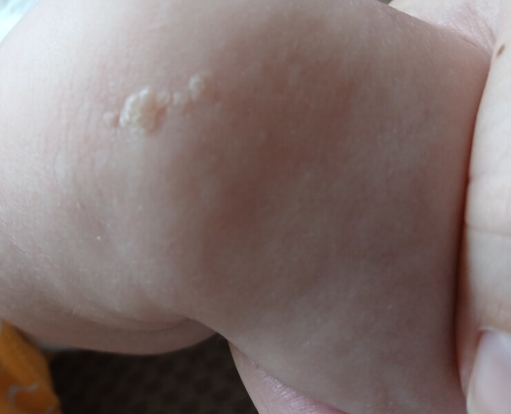 What's on my baby's leg?