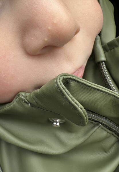 Milia or milk spots at 2?