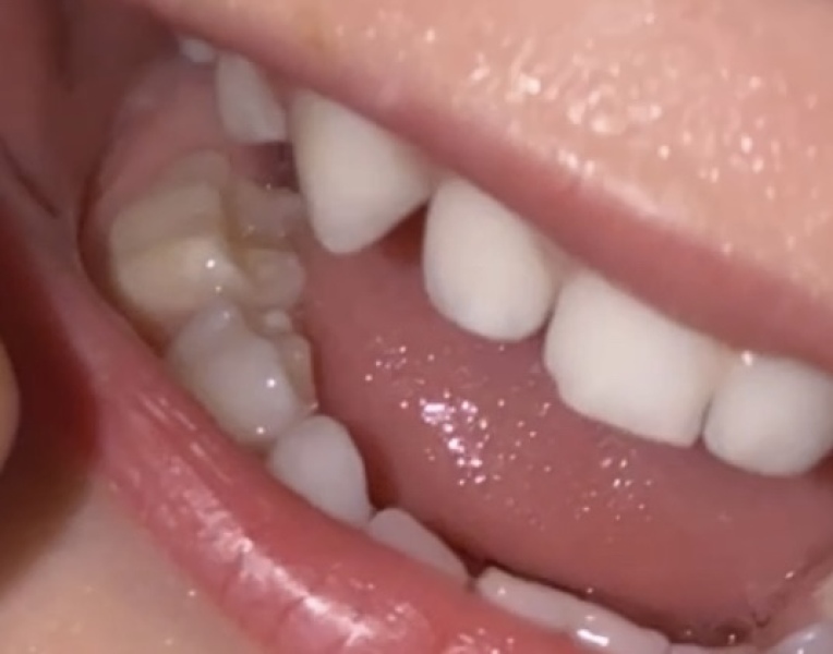 Help with toddlers teeth?