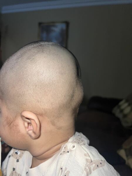 Dent in baby head