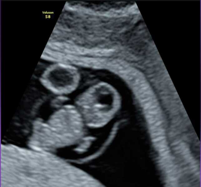 5 weeks and no symptoms - not even sore boobs