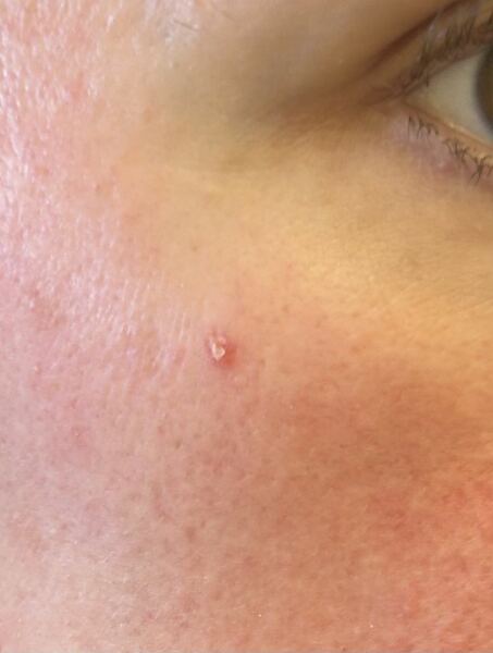 Are there any dermatologists here that can help please?