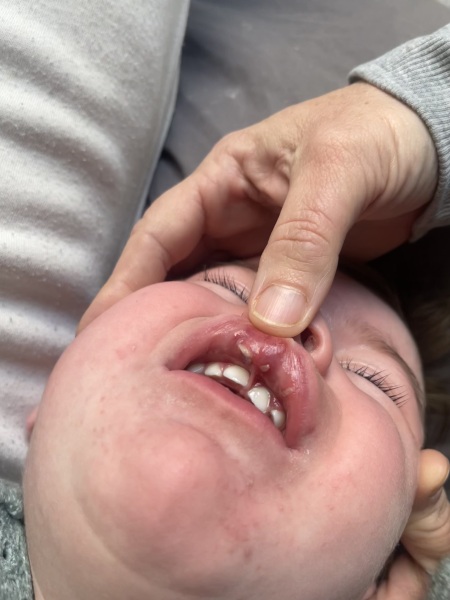 Is this part of a tooth stuck in toddlers lip?!