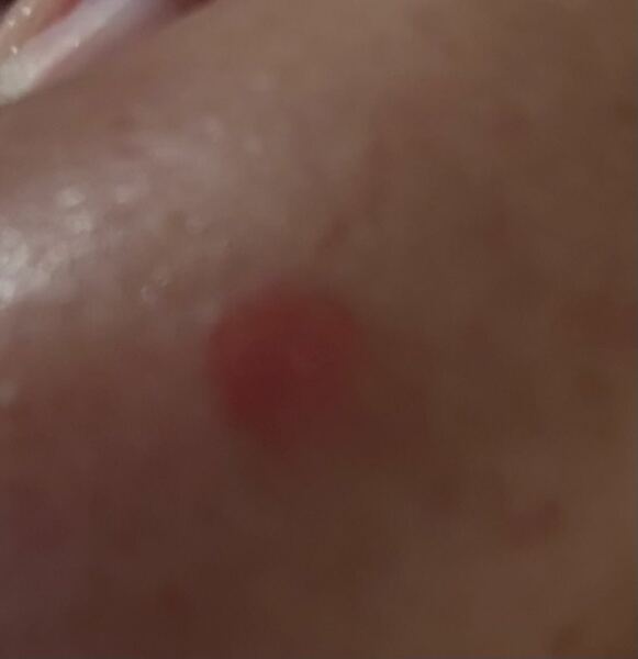 Nipple spots-pic included
