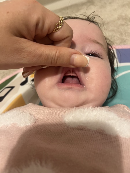 Is this a lip tie? Does it need fixed?