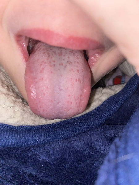 Could this be strawberry tongue?