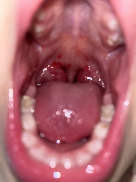 Bleeding tonsils