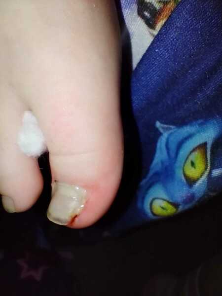 Toenail injury / infection