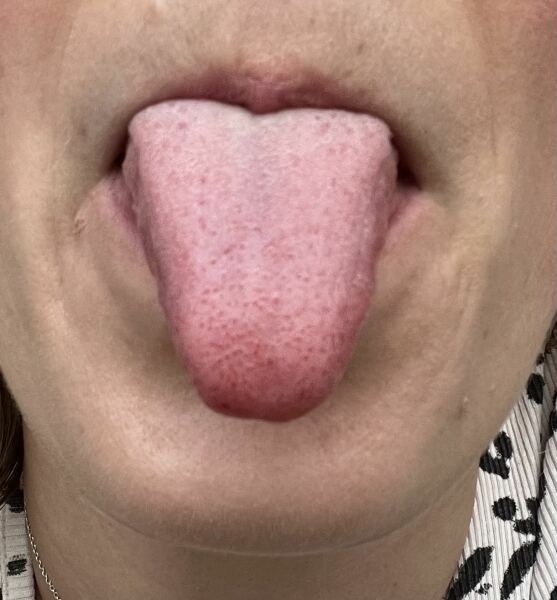 Tongue super red