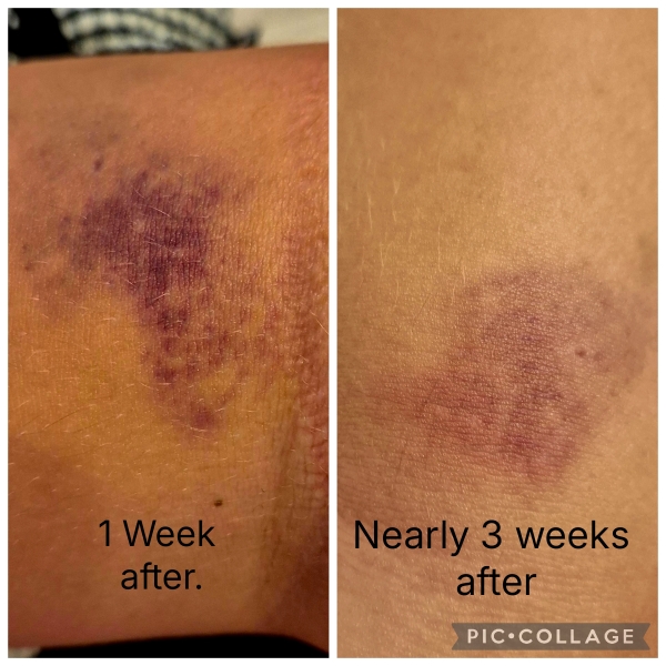 Blood Test Bruise