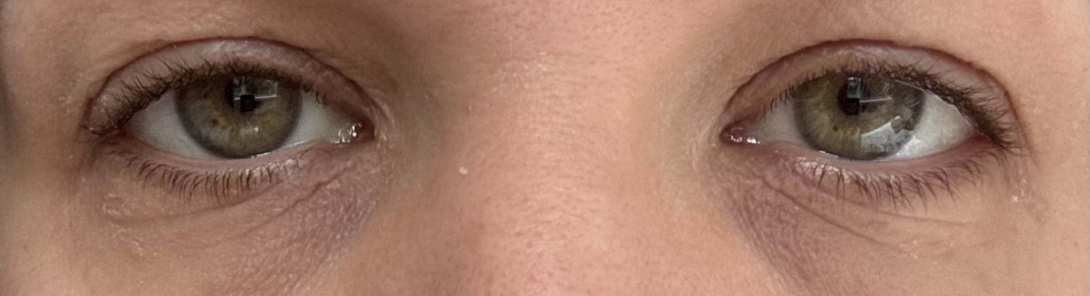 Blepharoplasty on NHS?