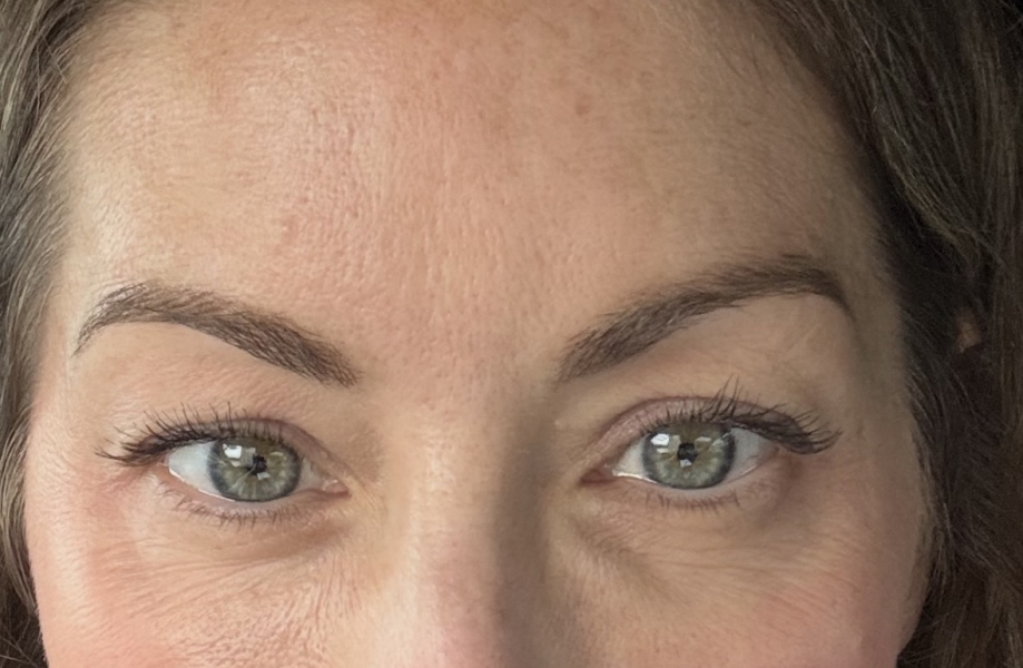 Tear trough filler, whats your experience?